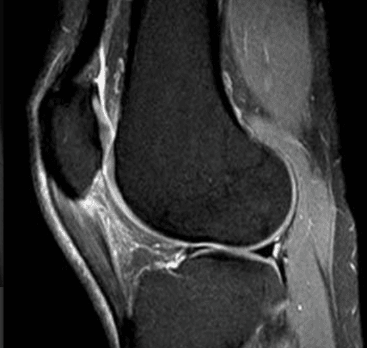 Sagittal MRI of the knee showing the joint and surrounding soft tissue, annotated for educational use.
