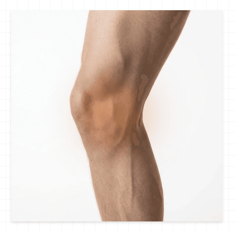 Pain on the Inside of the Knee