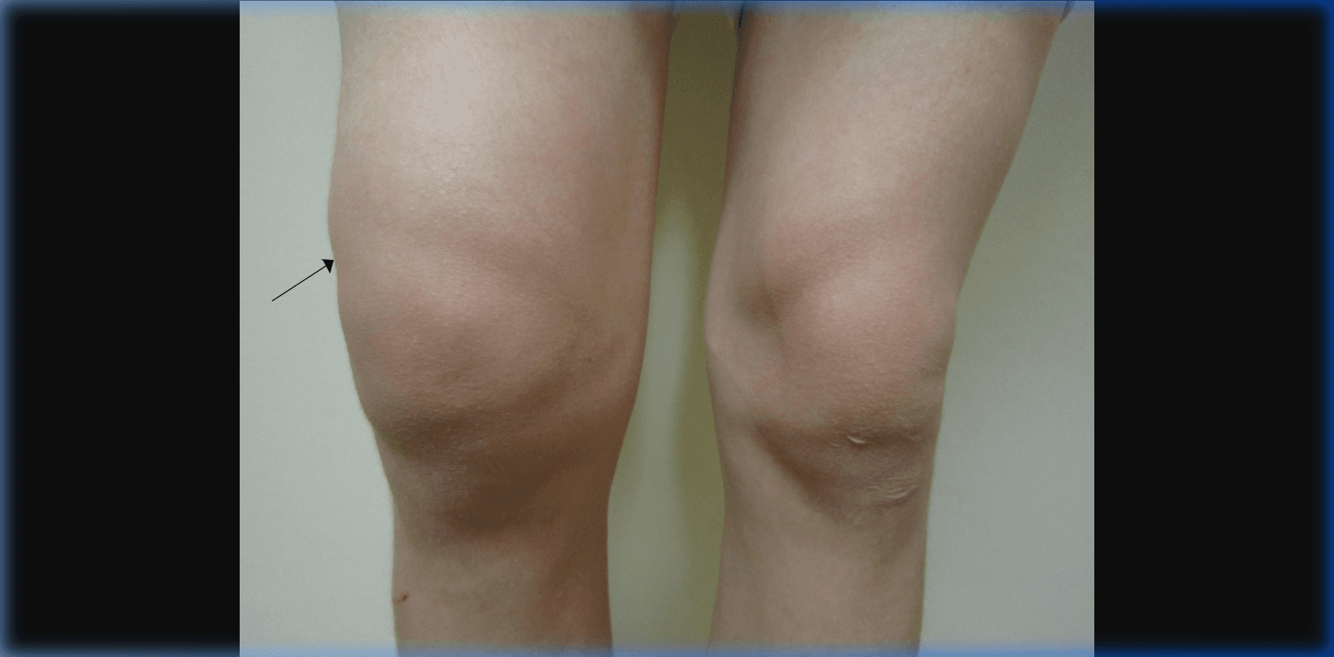 Swollen Knee